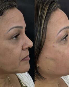 CHIN REDUCTION TREATMENT