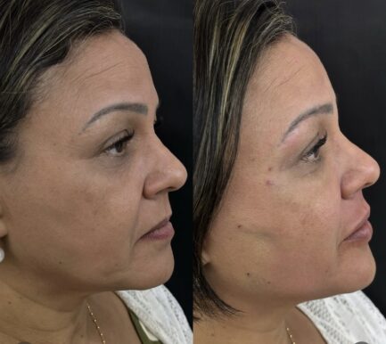 CHIN REDUCTION TREATMENT