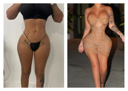NON SURGICAL BBL & HIP FILLERS
