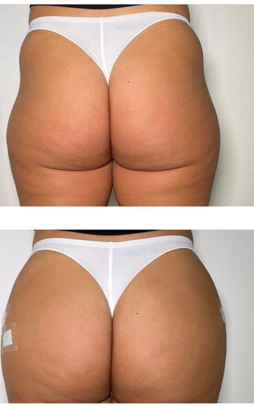 Radiesse Non-Surgical Butt Lift