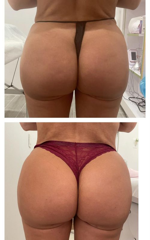 Radiesse Non-Surgical Butt Lift3
