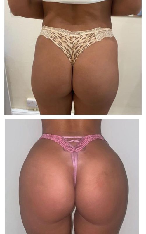 Radiesse Non-Surgical Butt Lift4